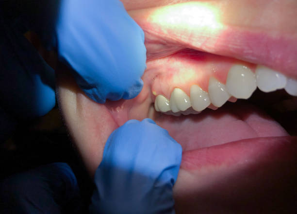 Best Emergency Tooth Extraction in Salyersville, KY